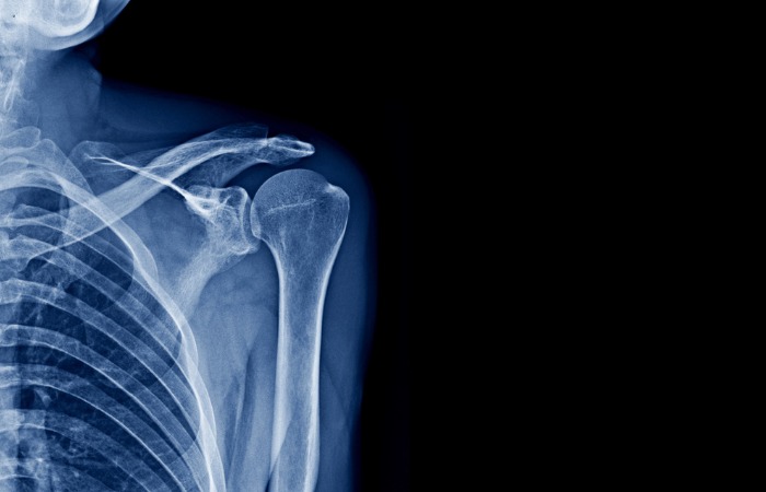 Digital Xray  Shoulder